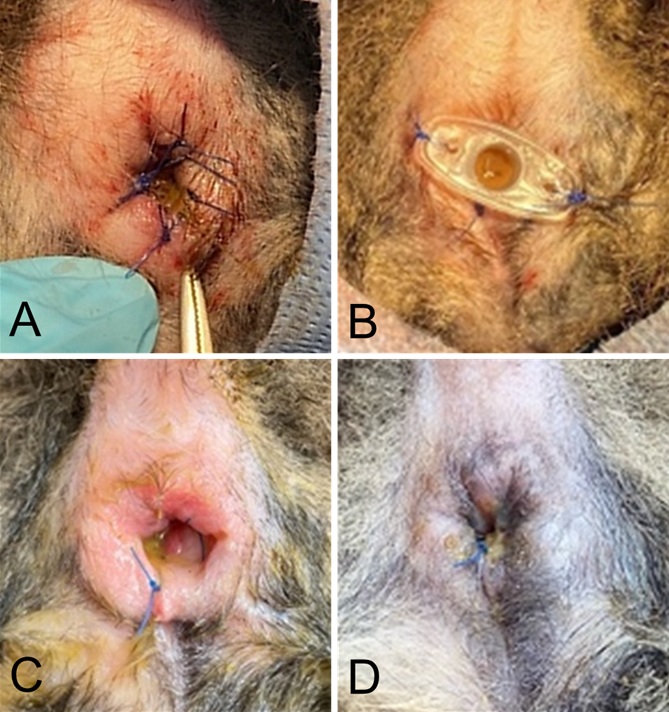 Figure 2. Surgical management and postoperative outcome of type III atresia ani. (A) Excision of the blind-ending rectal pouch with apposi-tion of the rectal mucosa and submucosa to the perineal skin using 3-0 polypropylene in a simple interrupted pattern. (B) Placement of a tem-porary 1-cc syringe port following anoplasty to prevent anal stenosis. (C) Perineal region on postoperative day 3 after removal of the syringe port due to obstruction by faecal material. (D) Completely healed anal wound on postoperative day 14.