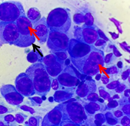 Multiple multinucleated cells (black arrow) and nuclear molding with coarse chromatin, prominent nucleoli (red arrow), anisocytosis, and anisokaryosis, consistent with malignancy (Diff-Quick staining, 100× magnification, oil immersion).
