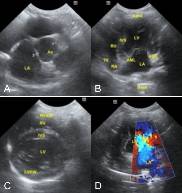 Figure 2. Echocardiographic findings of Lovi. (A) Enlargement of the left atrial chamber (LA), (B) thickening of the mitral valve leaflets (AML and PML), (C) endocardial thickening (LVPW), and (D) mitral valve regurgitation. Note: RVAW= Right Ventricular Anterior Wall, RV= Right Ventricle, IVS= Interventricular Septum, LV= Left Ven-tricle, RV= Right Ventricle, RA= Right Atrium, TV= Tricuspid Valve, Ao= Aorta.